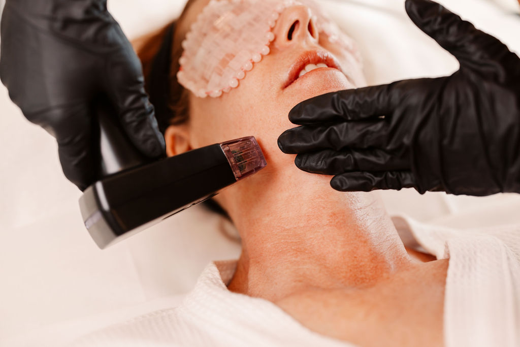 morpheus8 rf microneedling for skin tightening and wrinkles on northern beaches freshwater sydney