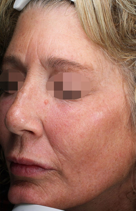 morpheus8 sydney botox filler laser IPL LED skincare northern beaches freshwater microneedling skin treatments clinic