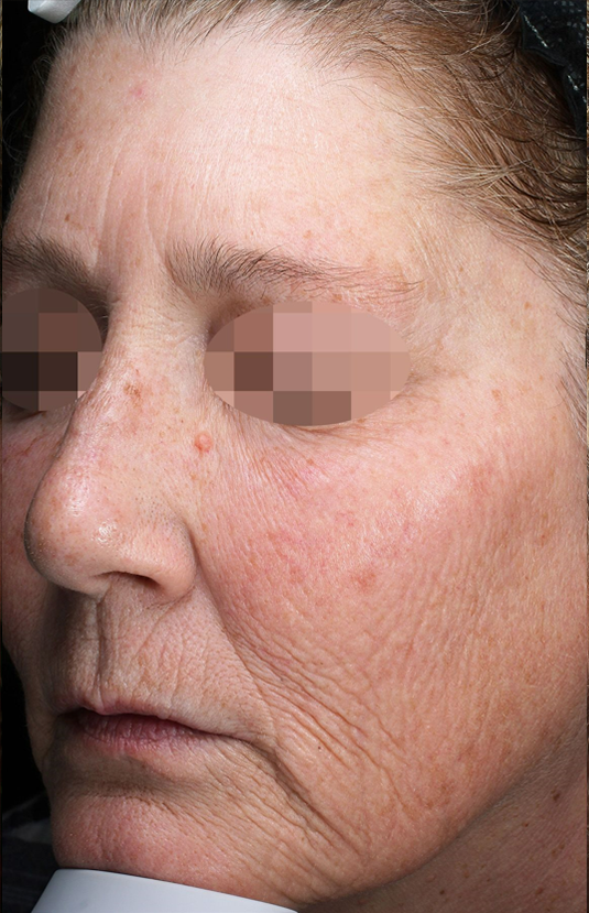 morpheus8 sydney botox filler laser IPL LED skincare northern beaches freshwater microneedling skin treatments clinic