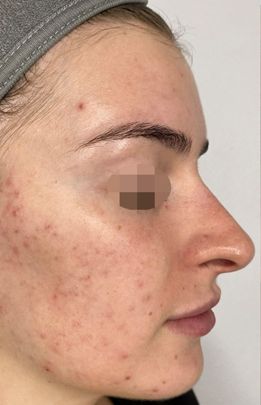 morpheus8 sydney botox filler laser IPL LED skincare northern beaches freshwater microneedling skin treatments clinic