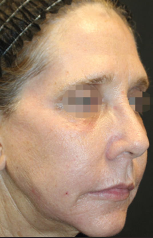 morpheus8 sydney botox filler laser IPL LED skincare northern beaches freshwater microneedling skin treatments clinic