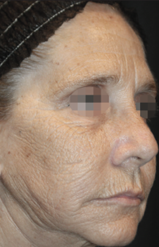 morpheus8 sydney botox filler laser IPL LED skincare northern beaches freshwater microneedling skin treatments clinic