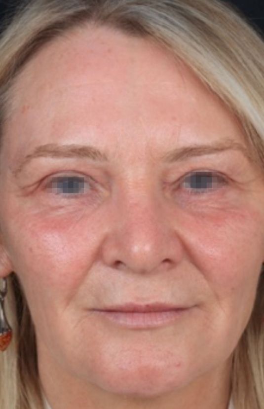 morpheus8 sydney botox filler laser IPL LED skincare northern beaches freshwater microneedling skin treatments clinic 10 morpheus8 sydney botox filler laser IPL LED skincare northern beaches freshwater microneedling skin treatments clinic