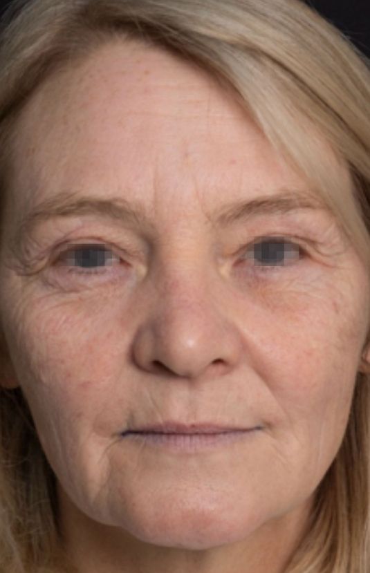 morpheus8 sydney botox filler laser IPL LED skincare northern beaches freshwater microneedling skin treatments clinic 9 morpheus8 sydney botox filler laser IPL LED skincare northern beaches freshwater microneedling skin treatments clinic
