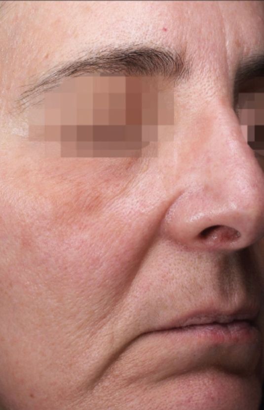morpheus8 sydney botox filler laser IPL LED skincare northern beaches freshwater microneedling skin treatments clinic 14 morpheus8 sydney botox filler laser IPL LED skincare northern beaches freshwater microneedling skin treatments clinic