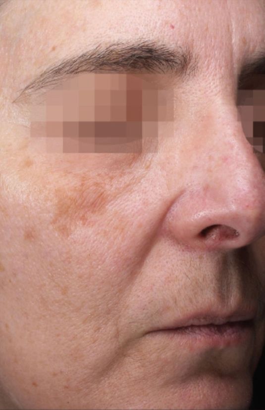 morpheus8 sydney botox filler laser IPL LED skincare northern beaches freshwater microneedling skin treatments clinic 13 morpheus8 sydney botox filler laser IPL LED skincare northern beaches freshwater microneedling skin treatments clinic