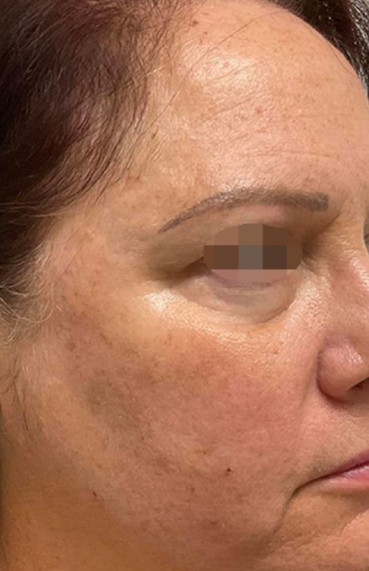 morpheus8 sydney botox filler laser IPL LED skincare northern beaches freshwater microneedling skin treatments clinic 12 morpheus8 sydney botox filler laser IPL LED skincare northern beaches freshwater microneedling skin treatments clinic