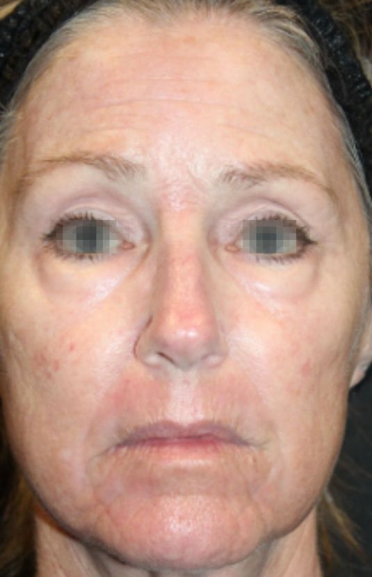 morpheus8 sydney botox filler laser IPL LED skincare northern beaches freshwater microneedling skin treatments clinic 8 morpheus8 sydney botox filler laser IPL LED skincare northern beaches freshwater microneedling skin treatments clinic