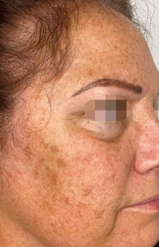morpheus8 sydney botox filler laser IPL LED skincare northern beaches freshwater microneedling skin treatments clinic 11 morpheus8 sydney botox filler laser IPL LED skincare northern beaches freshwater microneedling skin treatments clinic