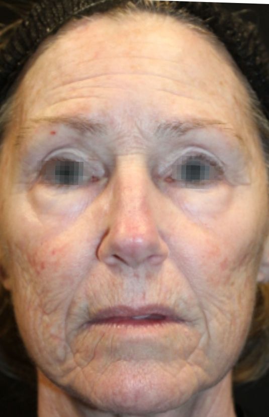 morpheus8 sydney botox filler laser IPL LED skincare northern beaches freshwater microneedling skin treatments clinic 7 morpheus8 sydney botox filler laser IPL LED skincare northern beaches freshwater microneedling skin treatments clinic
