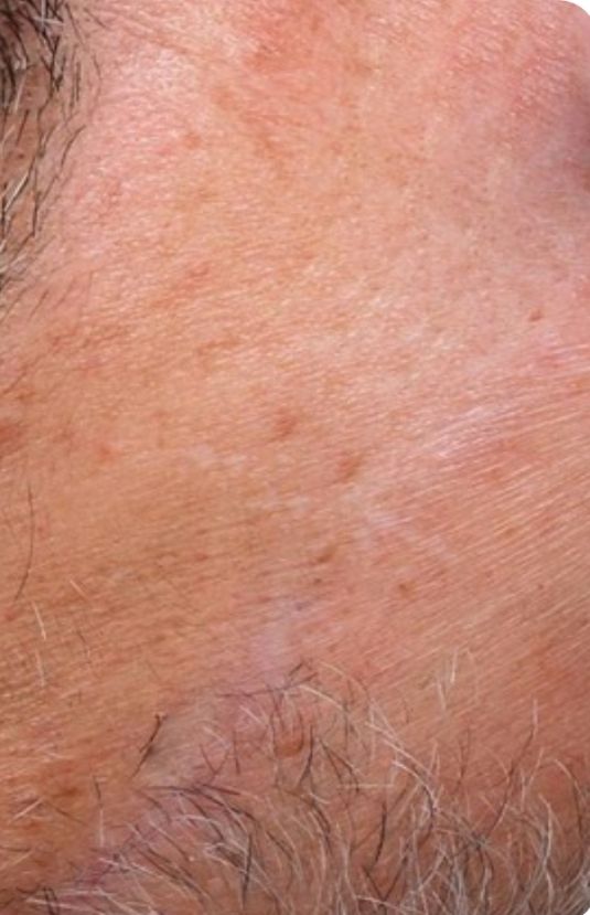 morpheus8 sydney botox filler laser IPL LED skincare northern beaches freshwater microneedling skin treatments clinic 17 morpheus8 sydney botox filler laser IPL LED skincare northern beaches freshwater microneedling skin treatments clinic