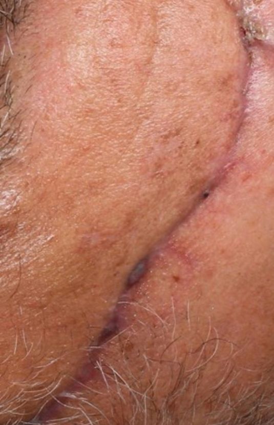 morpheus8 sydney botox filler laser IPL LED skincare northern beaches freshwater microneedling skin treatments clinic 16 morpheus8 sydney botox filler laser IPL LED skincare northern beaches freshwater microneedling skin treatments clinic