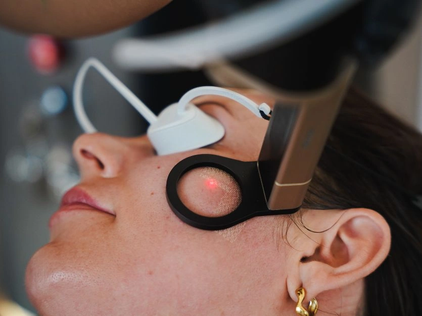 Alma Hybrid Scar Treatment at Sisä Skincare in Freshwater using dual-wavelength laser technology to improve the appearance of acne scars, surgical scars and traumatic scars.