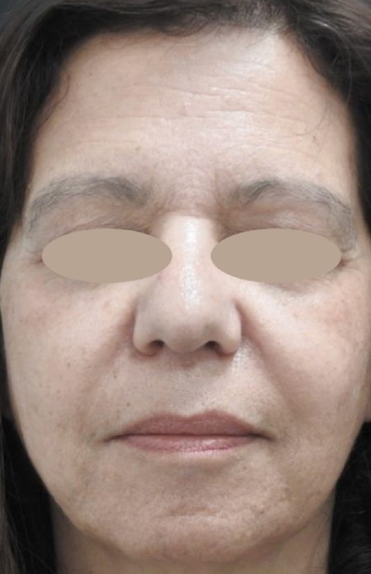 morpheus8 sydney botox filler laser IPL LED skincare northern beaches freshwater microneedling skin treatments clinic 7 morpheus8 sydney botox filler laser IPL LED skincare northern beaches freshwater microneedling skin treatments clinic
