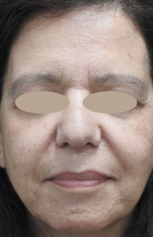 morpheus8 sydney botox filler laser IPL LED skincare northern beaches freshwater microneedling skin treatments clinic 6 morpheus8 sydney botox filler laser IPL LED skincare northern beaches freshwater microneedling skin treatments clinic