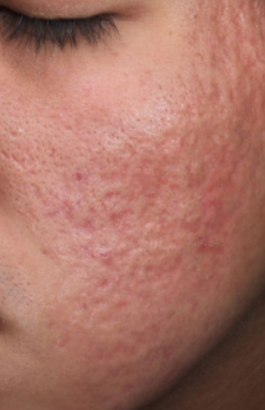 morpheus8 sydney botox filler laser IPL LED skincare northern beaches freshwater microneedling skin treatments clinic 5 morpheus8 sydney botox filler laser IPL LED skincare northern beaches freshwater microneedling skin treatments clinic