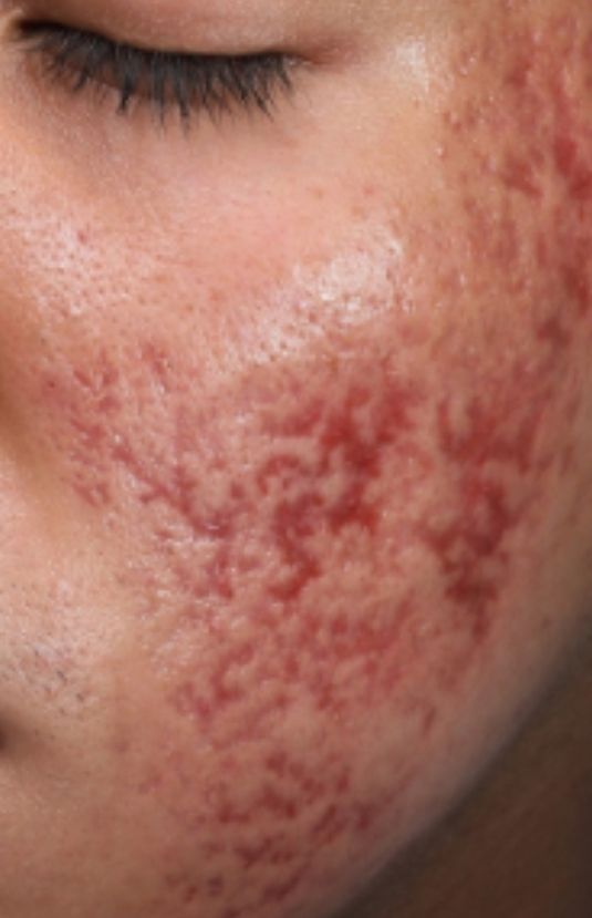 morpheus8 sydney botox filler laser IPL LED skincare northern beaches freshwater microneedling skin treatments clinic 4 morpheus8 sydney botox filler laser IPL LED skincare northern beaches freshwater microneedling skin treatments clinic