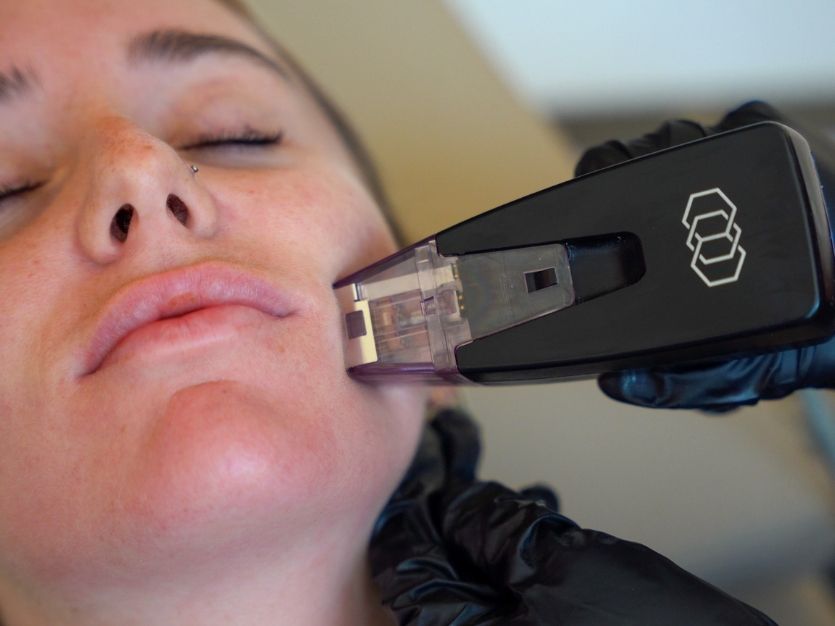 Morpheus8 RF Microneedling | Sisä Skincare Sydney