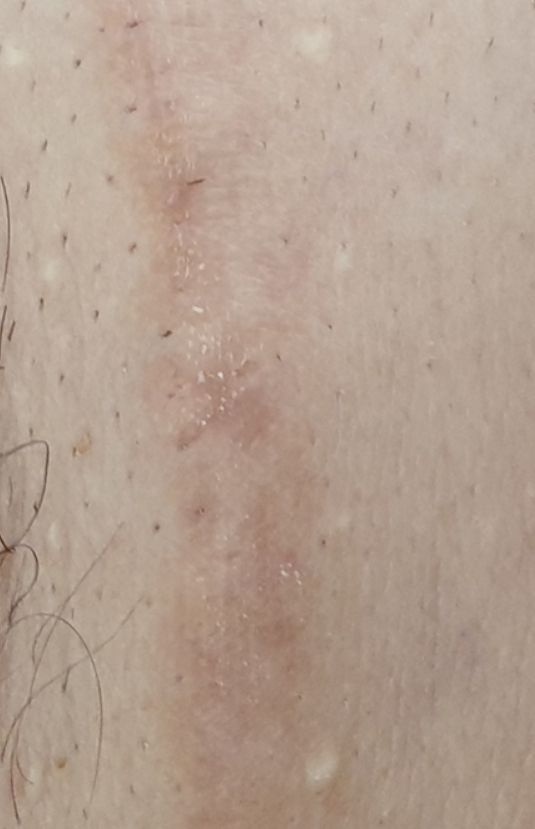 morpheus8 sydney botox filler laser IPL LED skincare northern beaches freshwater microneedling skin treatments clinic 13 morpheus8 sydney botox filler laser IPL LED skincare northern beaches freshwater microneedling skin treatments clinic