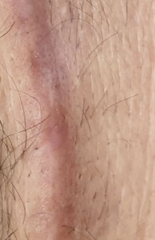 morpheus8 sydney botox filler laser IPL LED skincare northern beaches freshwater microneedling skin treatments clinic 12 morpheus8 sydney botox filler laser IPL LED skincare northern beaches freshwater microneedling skin treatments clinic