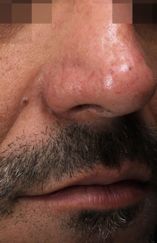 morpheus8 sydney botox filler laser IPL LED skincare northern beaches freshwater microneedling skin treatments clinic 15 morpheus8 sydney botox filler laser IPL LED skincare northern beaches freshwater microneedling skin treatments clinic