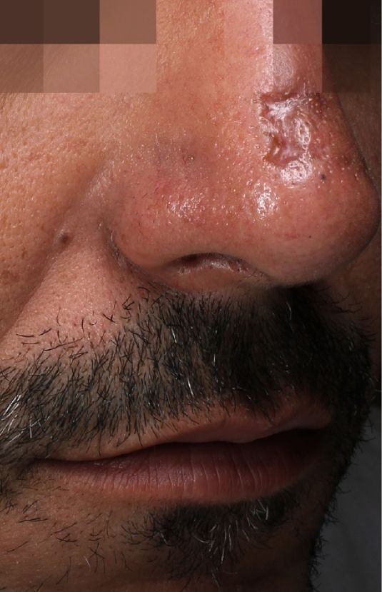 morpheus8 sydney botox filler laser IPL LED skincare northern beaches freshwater microneedling skin treatments clinic 14 morpheus8 sydney botox filler laser IPL LED skincare northern beaches freshwater microneedling skin treatments clinic