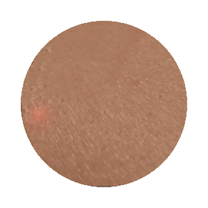 morpheus8 sydney botox filler laser IPL LED skincare northern beaches freshwater microneedling skin treatments clinic 12 Alma Hybrid CO₂ and erbium laser resurfacing treatment in progress at Sisä Skincare, Freshwater