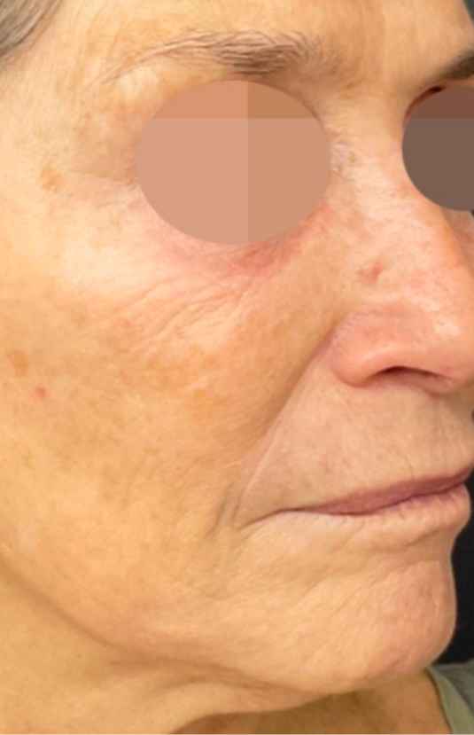 After Alma PixelPeel CO₂ laser resurfacing at Sisä Skincare. Individual results vary.