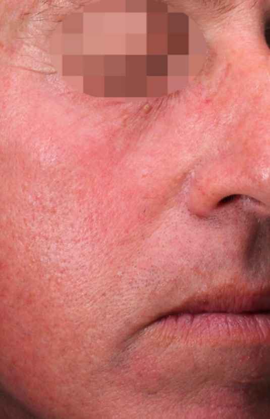 After Alma PixelPeel CO₂ laser resurfacing at Sisä Skincare. Individual results vary.