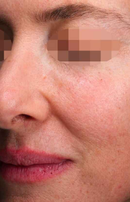 After Alma PixelPeel CO₂ laser resurfacing at Sisä Skincare. Individual results vary.
