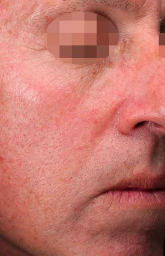 Before Alma PixelPeel CO₂ laser resurfacing at Sisä Skincare. Individual results vary.
