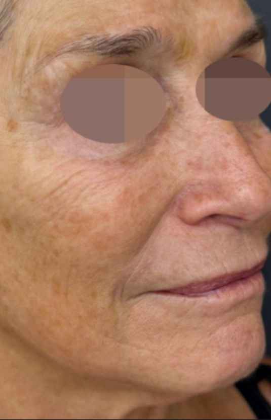 Before Alma PixelPeel CO₂ laser resurfacing at Sisä Skincare. Individual results vary.