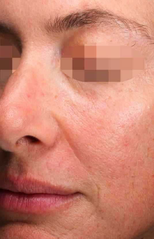 Before Alma PixelPeel CO₂ laser resurfacing at Sisä Skincare. Individual results vary.