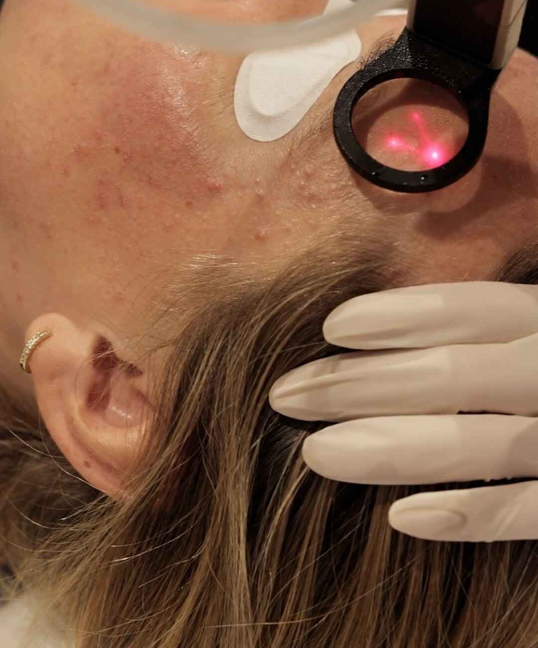 Alma PixelPeel CO₂ laser resurfacing treatment at Sisä Skincare, Freshwater