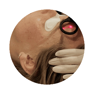 alma-pixelpeel-fractional-co2-laser-treatment-sisa-skincare.gif